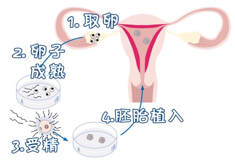 取卵手术室